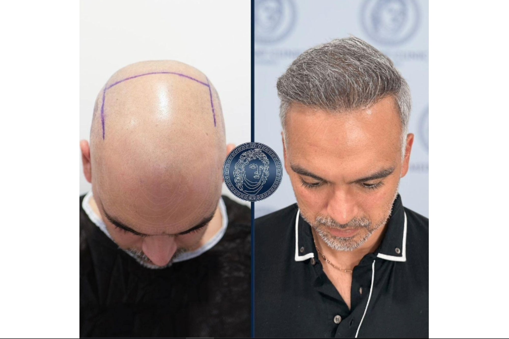 Aesthetic Excellence How Turkey’s Hair Transplant Centres Blend Artistry with Medical Expertise